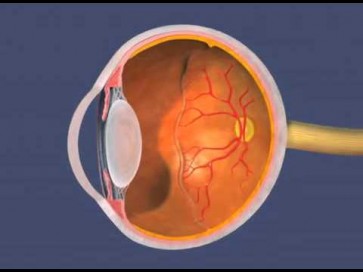 Retinopatía Del Prematuro | FEMEXER