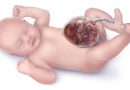 omphalocele