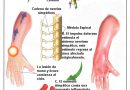 Sindrome de sudeck