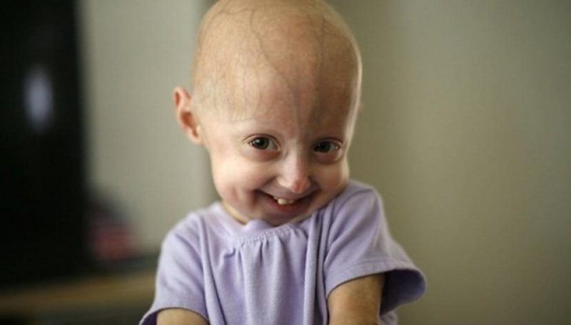 La Enfermedad De Benjamin Button S Existe FEMEXER   Progeria 800x456 