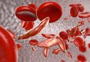 Anemia falciforme