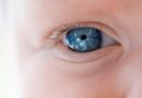 retinoblastoma