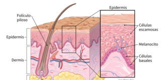 Melanoma