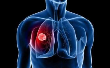 mesotelioma pleural