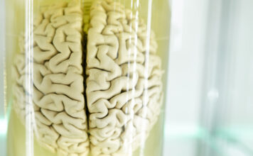 La atrofia del córtex cerebral se relaciona con apatía en pacientes de Huntington